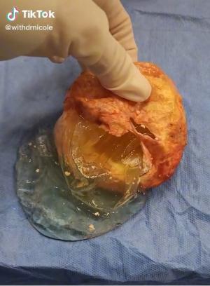 美 성형외과 의사, 36년 된 가슴 보형물 공개…“10년 이상 유지시 위험”